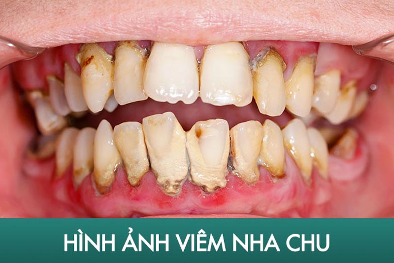 Cao răng càng nhiều càng làm tăng nguy cơ mắc các bệnh răng miệng