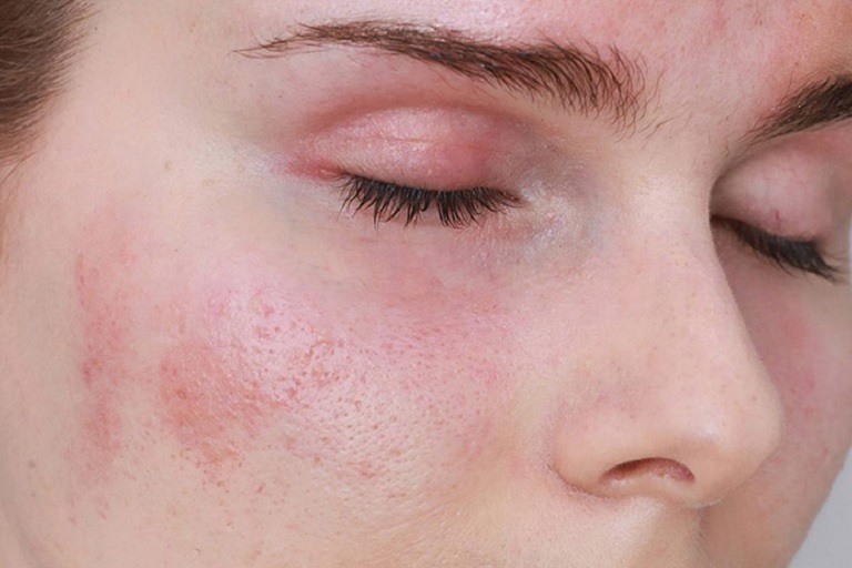 Da mặt bị đỏ rát và ngứa khiến người bệnh khó chịu và gây mất thẩm mỹ