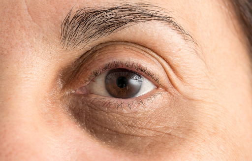 Tại sao thức khuya mắt thâm và cách điều trị hiệu quả 2